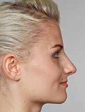 Postoperativ - Ergebnis